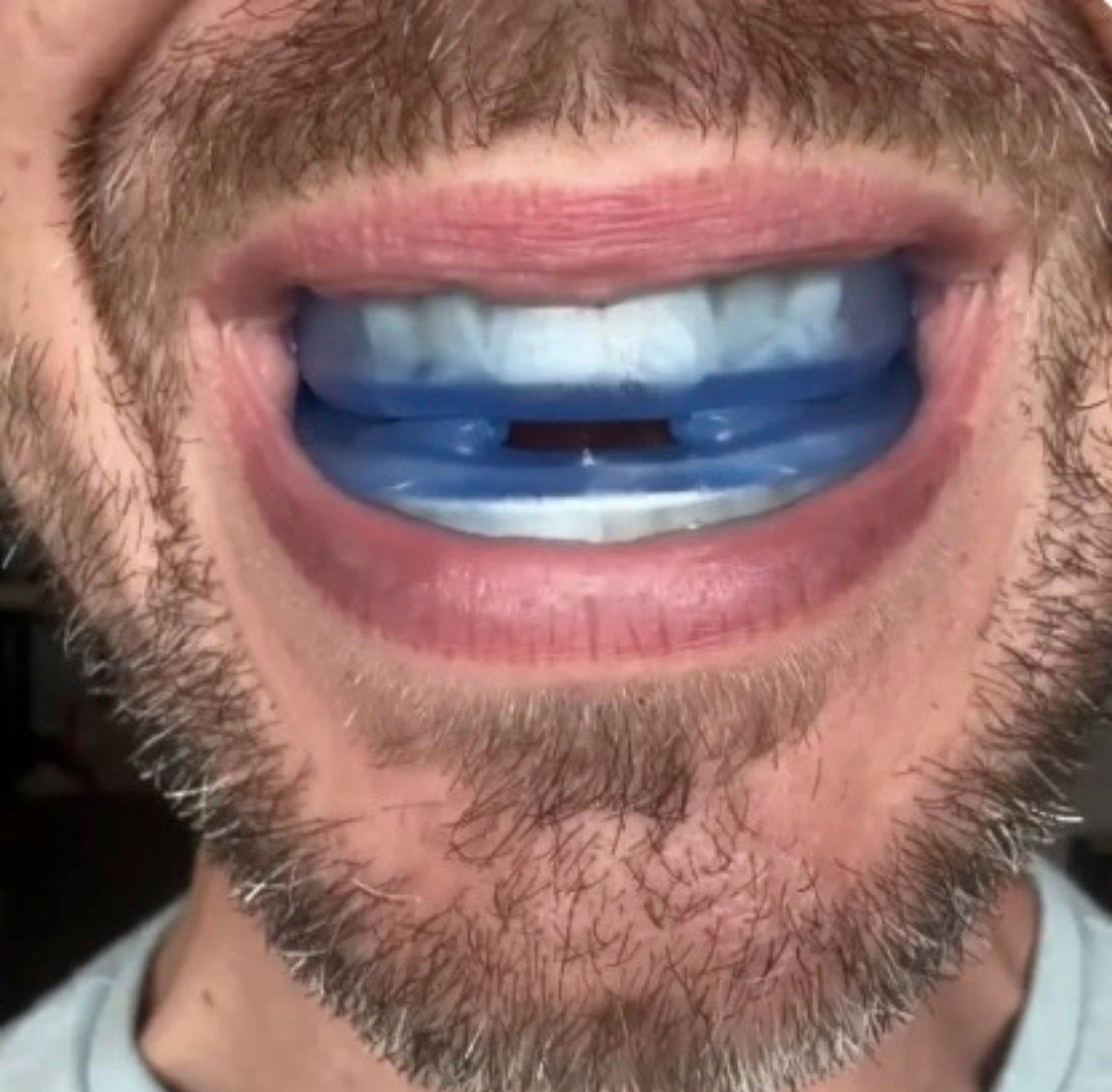 SILEN™ イビキマウスピース